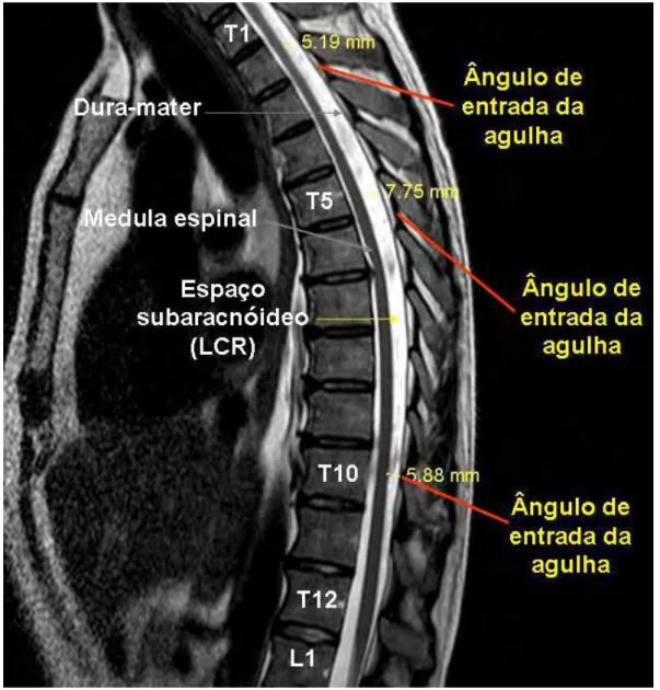Figura 2 - Ressonância magnética de imagem da coluna vertebral e medula espinal nas  regiões cervical, torácica e lombar
