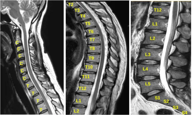 Figura 9 - RMI mostrando toda a relação entre a medula espinal e as partes anteriores e  posteriores do canal medular