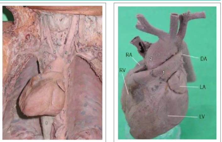 Figure 1 - Position of heart in the thorax: 1 - pulmonary trunk; 2 - ascending  aorta; 3 - superior vena cava; 4 - brachiocephalic trunk; 5 - left common carotid  artery; 6 - left subclavian artery; 7 - thoracic aorta; 8 - hepatic tissue covering  the infe