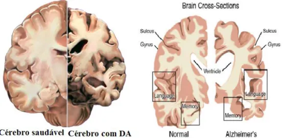 FIGURA 1. 1 - Comparação entre cérebros de pacientes saudáveis e afetados pela  DA.  Em  cérebros  com  DA  observa-se  aumento  dos  ventrículos  e  diminuição  do  córtex