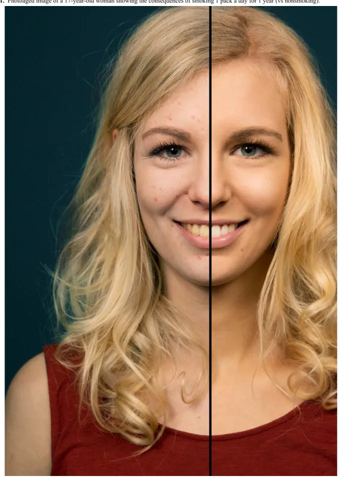 Figure 1.  Photoaged image of a 17-year-old woman showing the consequences of smoking 1 pack a day for 1 year (vs nonsmoking).