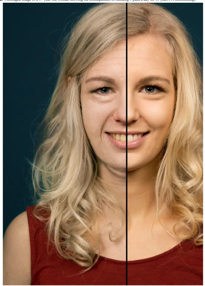 Figure 2.  Photoaged image of a 17-year-old woman showing the consequences of smoking 1 pack a day for 15 years (vs nonsmoking).