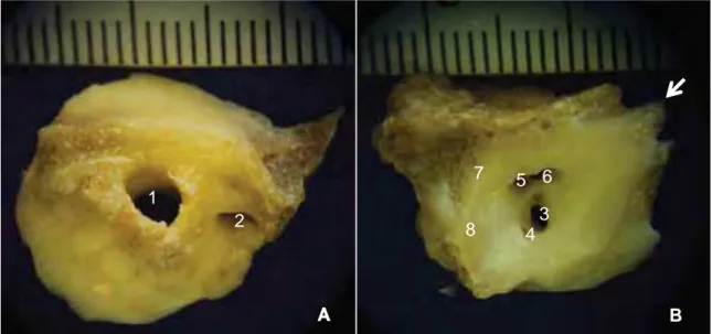 Figura 5. Em  A, fotografia da bula timpanica de uma paca adulta, vista lateral, onde se  observa:  1  forame  externo do canal do nervo facial e 2 conduto auditivo externo