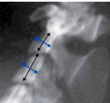 Figure 2 - Digital radiography in lateral view of cervical vertebrae (C2 and C3)  of adult rat, for linear measurement.