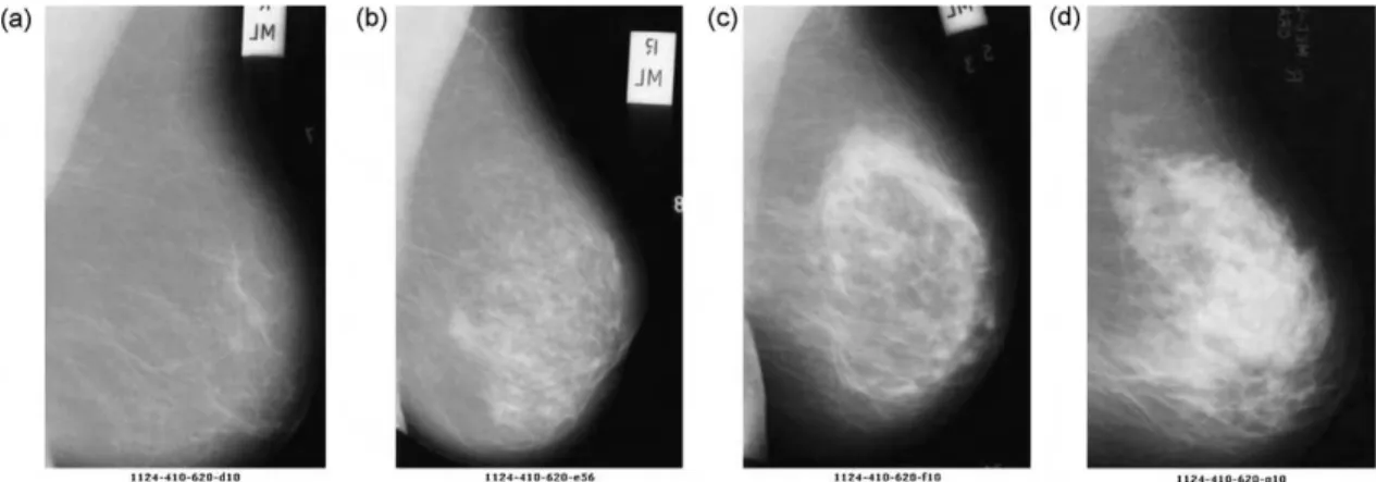 Fig. 1 – Mammographies of different breast tissues: (a) almost entirely fatty, (b) scattered fibroglandular fatty , (c) heterogeneously dense, and (d) extremely dense.