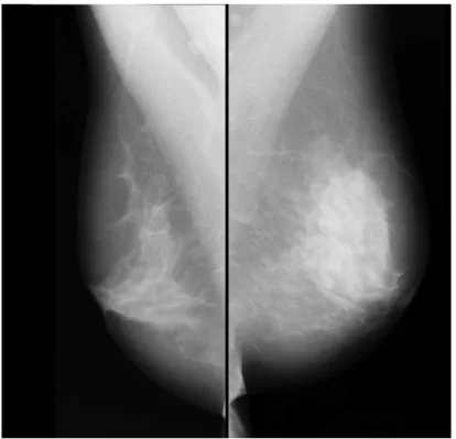 Figura 4.1: Exemplo de um par de mamogramas (vista MLO) de um mesmo paciente, contido no banco de dados Mini-MIAS.( SUCKLING et al