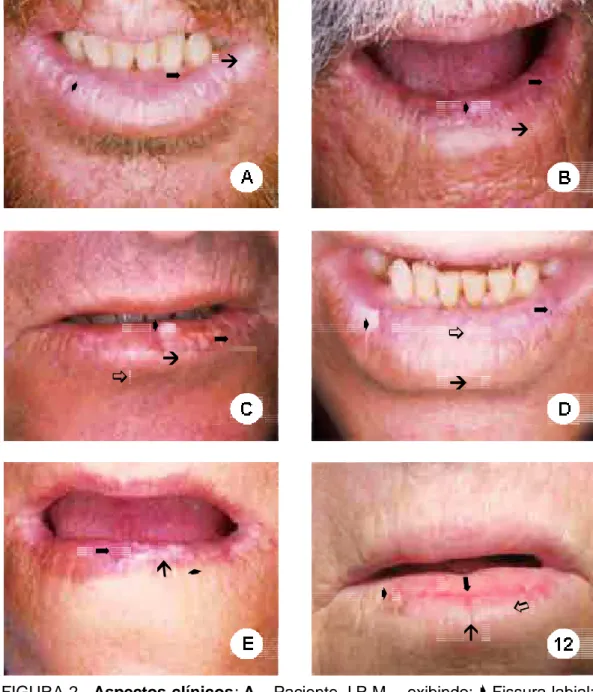 FIGURA 2 - : - Paciente J.R.M., exibindo: Fissura labial; Manchaseplacasbrancas; Áreaeritematosa; Paciente J.T.S