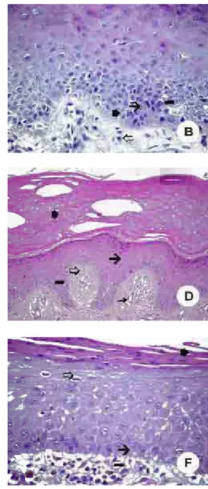 FIGURA 5- : Camada de hiperortoqueratina; Hiperplasiaepitelial; Infiltrado inflamatórioleve (H/E 100X); Perda da polaridade das células; ucléolos evidentes; Hipercromatismo e Infiltrado inflamatório leve (H/E 400X); Camada de ortoqueratina; Atrofia epiteli