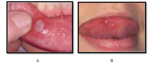 Fig. 5 A. Úlcera da mucosa do lábio; B. Úlceras Herpetiformes na língua. (Adaptado  de: RZ Cui et al., 2016)