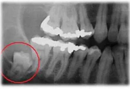 Fig 5. Terceiro molar  inferior