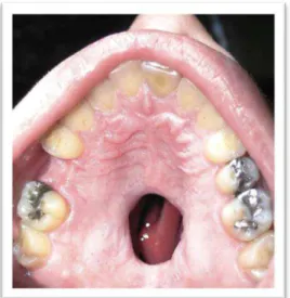 Figura 2: Abrasões cervicais  (Navya, 2008)