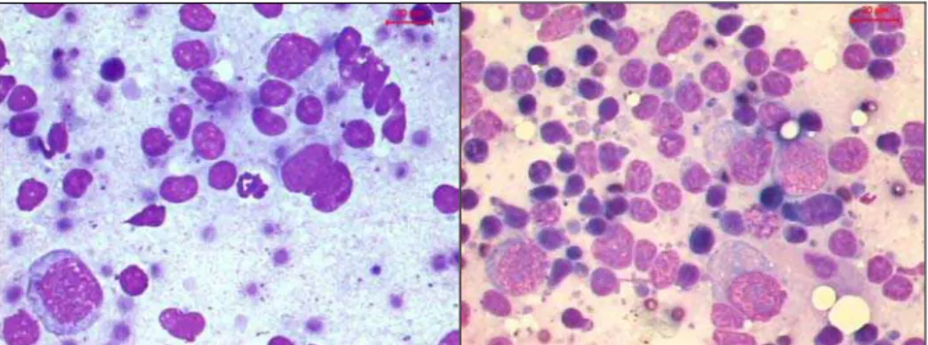 Figura 8 – Esfregaços com reação linfohistiocitária, edema, ausência  de destruição celular e de forma bacteriana