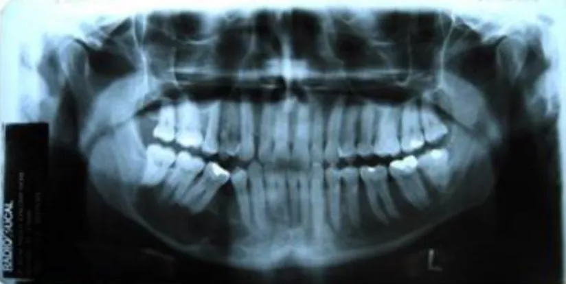 Figura 6  –  radiografia panorâmica dos maxilares, demonstra lesão da região apical dos elementos  44,46,47,48 