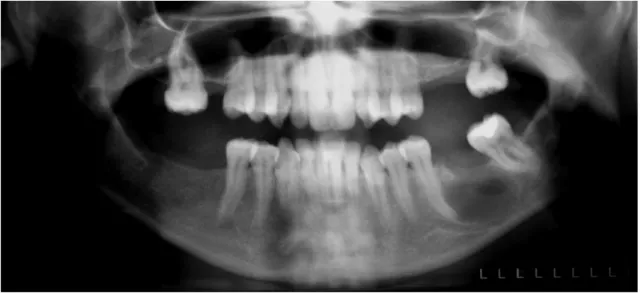 Figura 8 – radiografia panorâmica de um quisto radicular com origem no dente 36 ausente Fonte: Pedro Simões Costa, FMP, 2009 