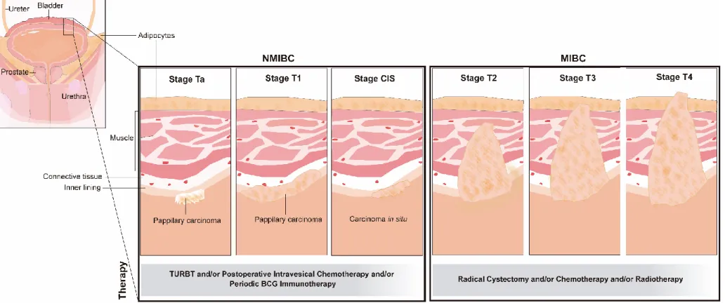 Figure  1.  Bladder  cancer  stages  and  recommended  therapy.  The  treatment  of  superficial  tumors  (papillary  or  CIS)  includes  transurethral resection of the tumor, which may be followed by postoperative intravesical chemotherapy and/or a long-t