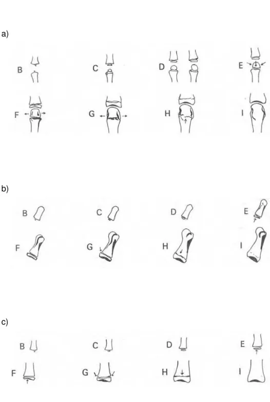 FIGURA 6 – Estágios de maturação óssea: a) para os metacarpos III e V; b) para a falange proximal I; c) para as falanges proximais III e V