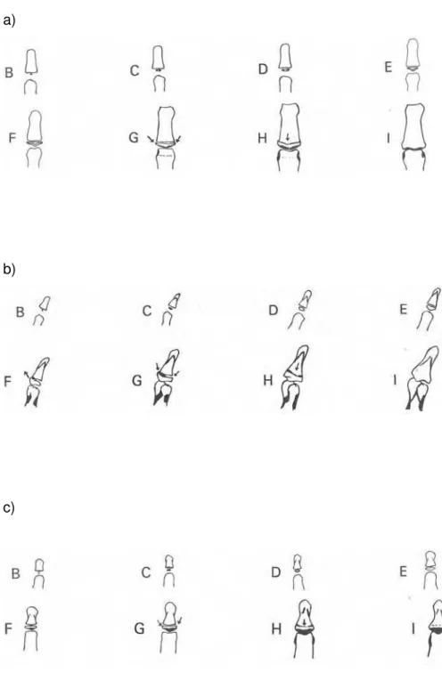 FIGURA 7 – Estágios de maturação óssea: a) para a falange distal I; b) para as falanges médias III e V; c) para as falanges distais III e V