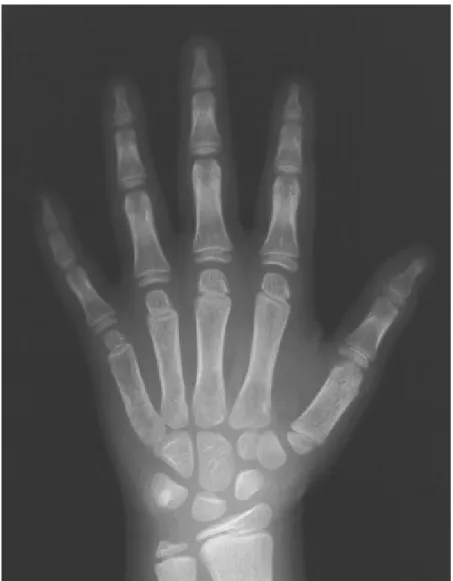 FIGURA 8 – Radiografia de mão e punho de indivíduo com síndrome de Down, sexo feminino, 6,91 anos de idade cronológica