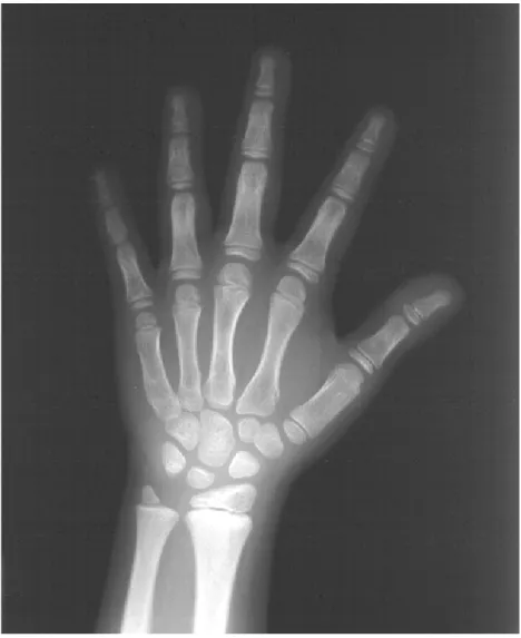 FIGURA 9 – Radiografia de mão e punho de indivíduo com síndrome de Down, sexo masculino, 9,41 anos de idade cronológica