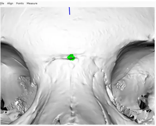Figure 3.19: Neighbouring algorithm applied to the nasion