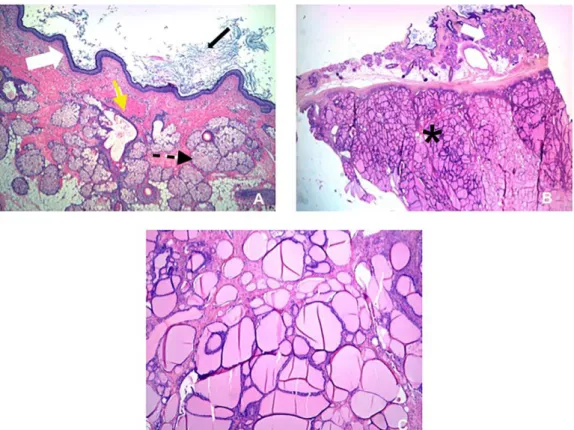 Table 1: Summary table of mature cystic teratoma with high proportion of thyroid tissue characteristics