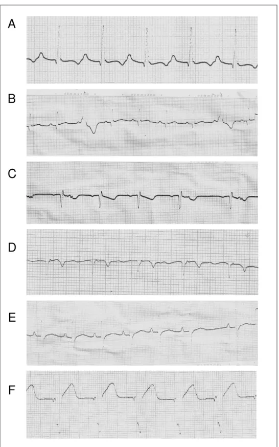 Figura 9 - Traçados eletrocardiográficos obtidos de cães infectados por 2.000 tripomastigotas/kg  das cepas VL-10, AAS ou Berenice-78 do T.cruzi