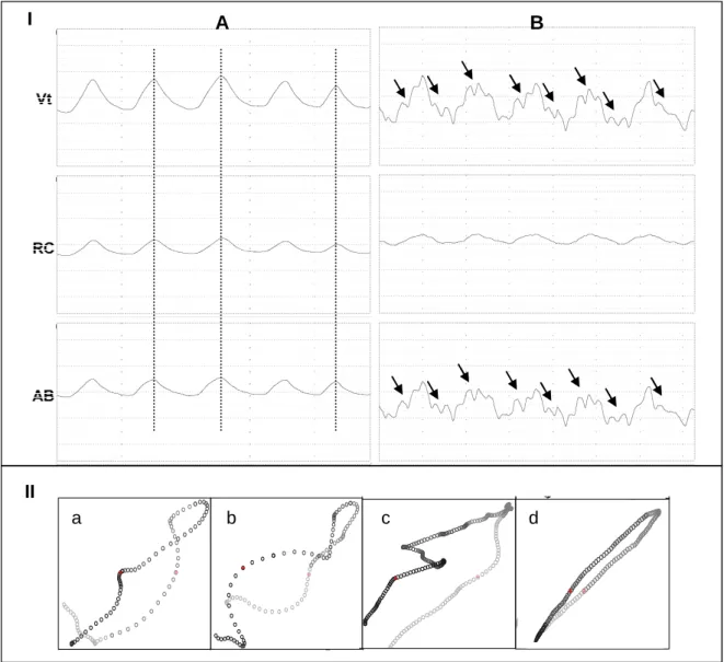 Figura 1: Example of typical waveforms at rest (A) and during exercise (B) on  panel I, and Konno-Mead loops with &#34;8 figure” (a, b and c) and without &#34;8 