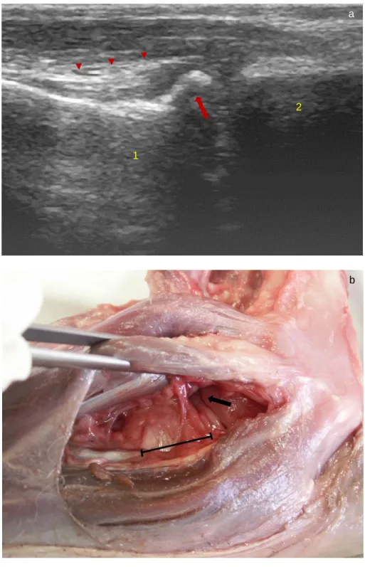 Figure 3.6 Relation between the ultrasound image and anatomical dissection  from biceps brachii/brachialis muscles ulnar insertion tendons and the medial  coronoid  disease