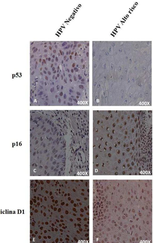 Figura 6: Fotomicrografias representativas de imunohistoquímica para as proteínas, p53,  p16  e  ciclina  D1