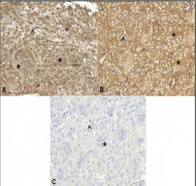 Fig 2. Immunolocalization of MMP14 and VIM in primary samples of GCTB. (A)  MMP14; (B) VIM1; (C) negative control (original magniﬁcation 400X)