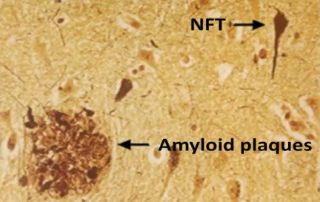 Figure  1  –  Two  histopathological  hallmarks  of  AD:  Amyloid  plaques  (AP)  and  Neurofibrillary  tangles  (NFTs) 20 .