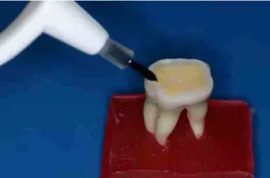 Figura 15: Aplicação do sistema adesivo auto-condicionante Primer ED, presente do kit do  Panávia F, sobre a superfície dental (Kuraray Medical Inc, Japan)