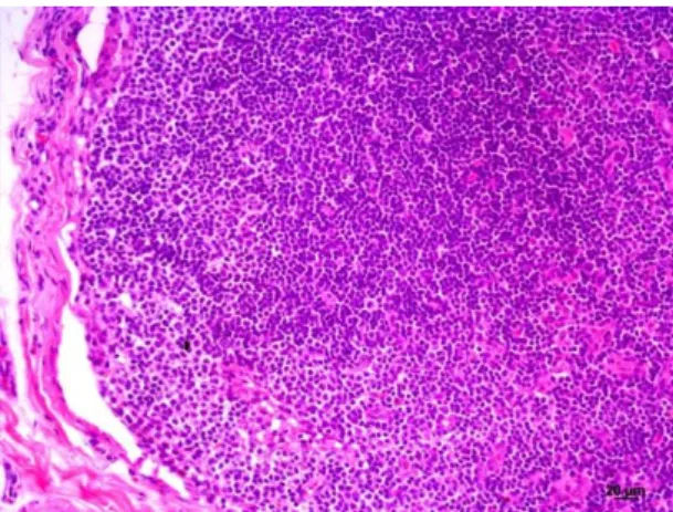 Figura 2. Fotomicrografia de linfonodo axilar  direito (paciente10), evidenciando a presença de  metástase