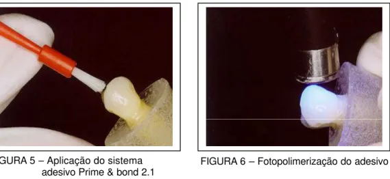 FIGURA 5 – Aplicação do sistema  adesivo Prime &amp; bond 2.1  (Dentsply) 