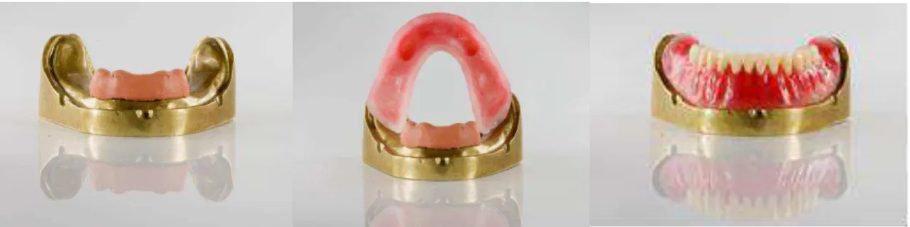 Figura 6 a - Confecção de alívio e base de prova da prótese total em cera  com dentes artificiais