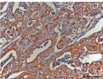 Figura  1  Imunorreactividade  para  a  Glicoproteína  P  (Score  3)  avaliado  num  carcinoma  cribriforme (Estalão=50μm)