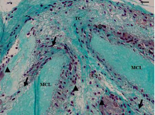 Figura 6: Corte histológico da pele de rato Wistar com implantes de matriz de colágeno  liofilizada (MCL), correspondendo ao grupo AV 30 dias: região da derme –  Matriz de colágeno liofilizada (MCL), Tecido Conjuntivo (TC), Capilares  Sanguíneos (CS), Fibr