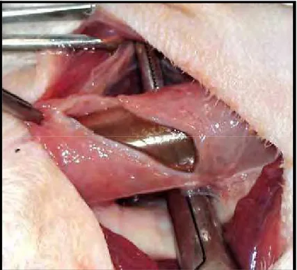 Figura 5 - Esofagectomia torácica por invaginação retrógrada:  Incisão em bisel do esôfago cervical