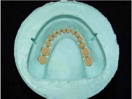 FIGURA 2 – Dentes artificiais posicionados na matriz de silicone. 
