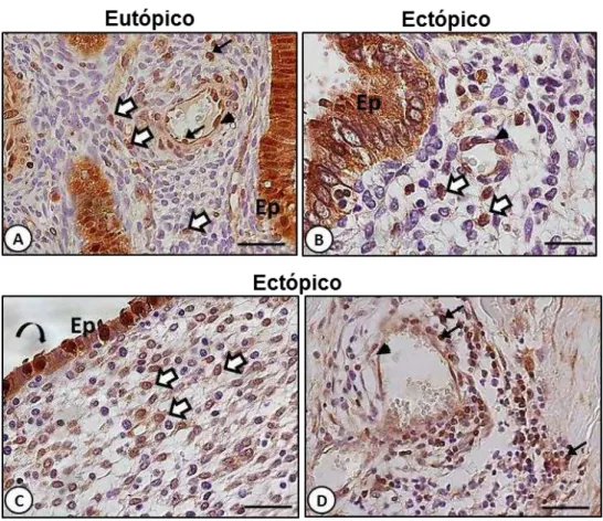 Figura  8.  Expressão  da  proteína  ANXA1  nos  endométrios  eutópico  e  ectópico.  Endométrio  eutópico  [A]  e  ectópico  [B-D]  demonstrando  imunorreatividade  positiva  para  ANXA1  nas  células  epiteliais  glandulares  (Ep),  endotélio  (cabeças  