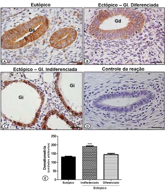 Figura  10.  Expressão  da  proteína  ANXA1  nas  células  epiteliais  glandulares  endometriais
