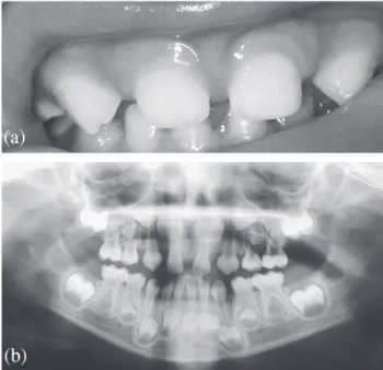 Figure 2 (a) Developmental absence of the primary upper lateral incisors  in a 3-year-old child