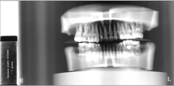 FIGURA 13-  Radiografia do manequim no aparelho radiográfico panorâmico  PANOURA 10 com plano oclusal à -5 graus em relação ao plano  horizontal.