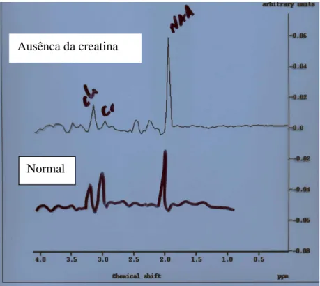 FIGURA 4 – Ausência da creatina na  ressonância magnética cerebral com  espectroscopia 