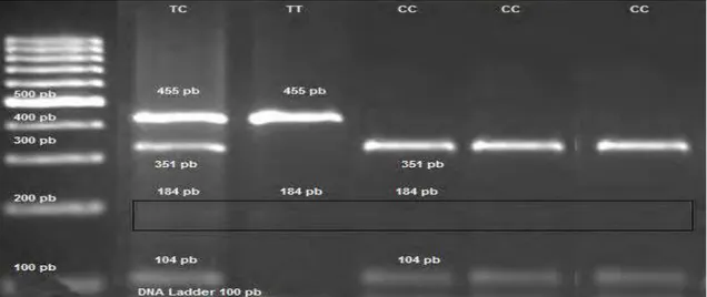 Figura 6. Representação dos 3 padrões de migração obtidos pela técnica de  PCR-RFLP/BsrI para o gene ACRP30