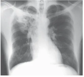 Fig. 1 - Posterior-anterior chest radiography demonstrating pulmonary infiltrate in the upper right lobe (Patient No
