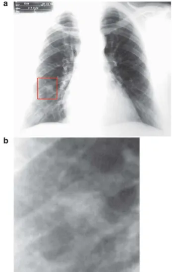 Fig. 4 - Posterior-anterior chest radiography demonstrating mediastinal lymph node enlargement (Patient No