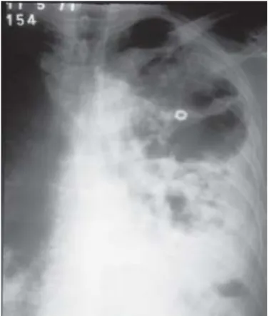 Fig. 3 - Chest X-Ray of patient 7 showing a nodule and a huge cavity with thick walls in SRL.