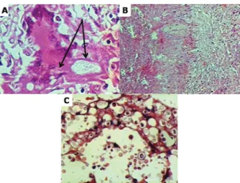 Fig.  1  - Section  of  the  lung  stained  with  HE.  Histologic  patterns  of  cryptococcosis