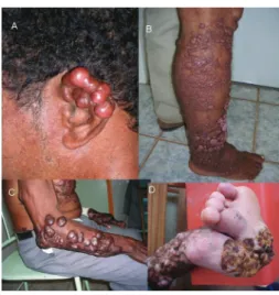 Fig. 2 - Characteristic clinical forms of Jorge Lobo’s disease. A. Isolated form; B. Multifocal  form on lower limb; C
